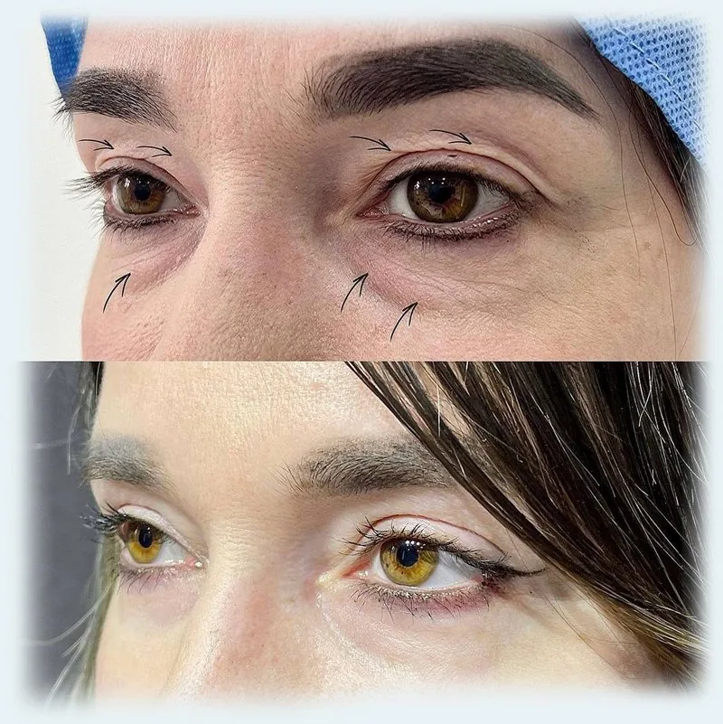 Eyelid Surgery (Blepharoplasty)