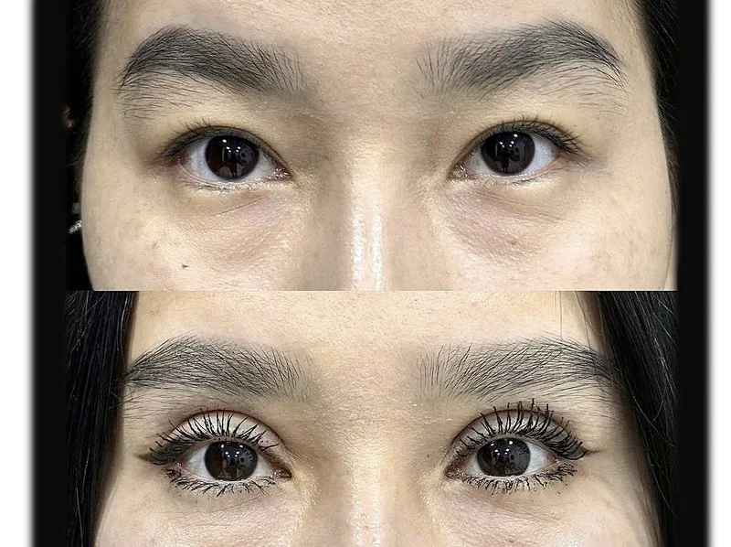 Eyelid Surgery (Blepharoplasty)