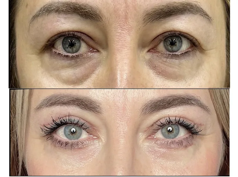 Eyelid Surgery (Blepharoplasty)