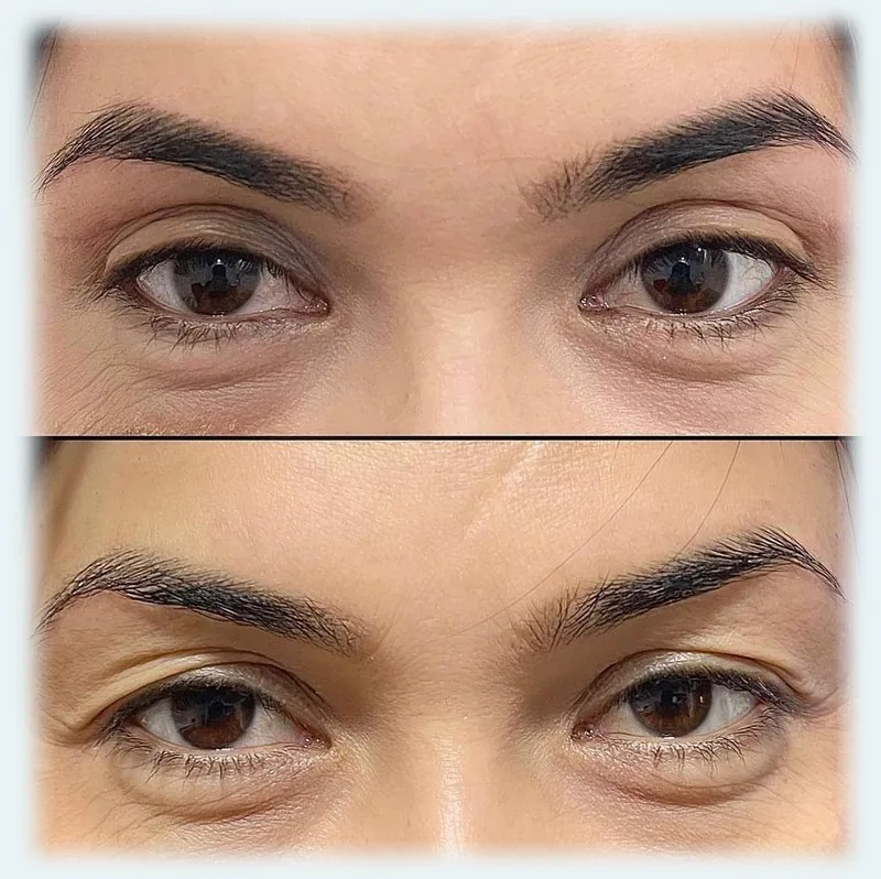 Eyelid Surgery (Blepharoplasty)
