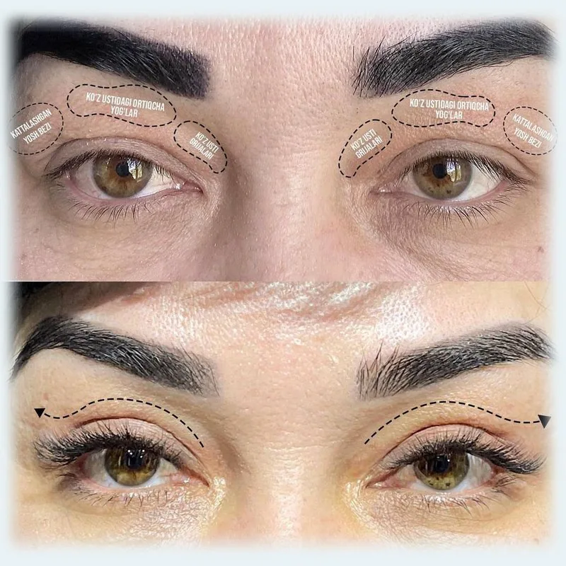 Eyelid Surgery (Blepharoplasty)