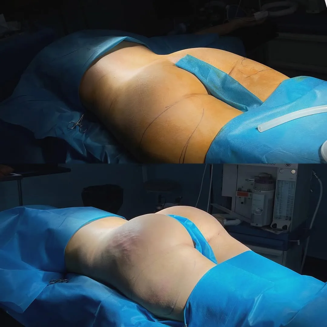 Липосакция 360°