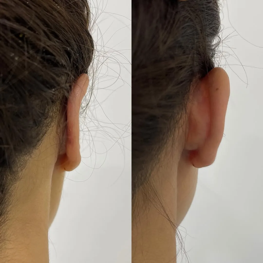 Otoplasty (Ear Surgery)