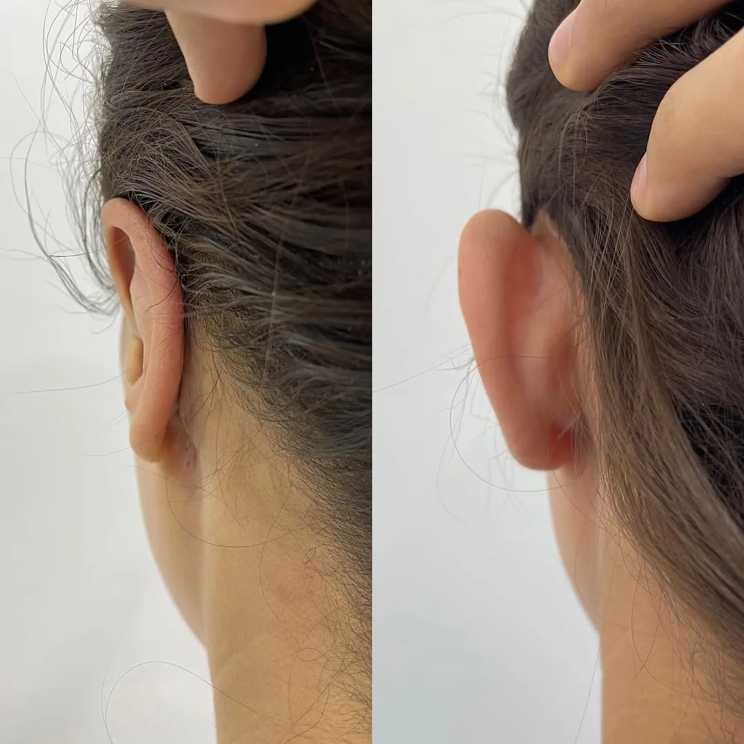 Otoplasty (Ear Surgery)