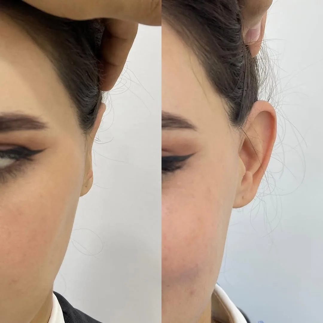 Otoplasty (Ear Surgery)