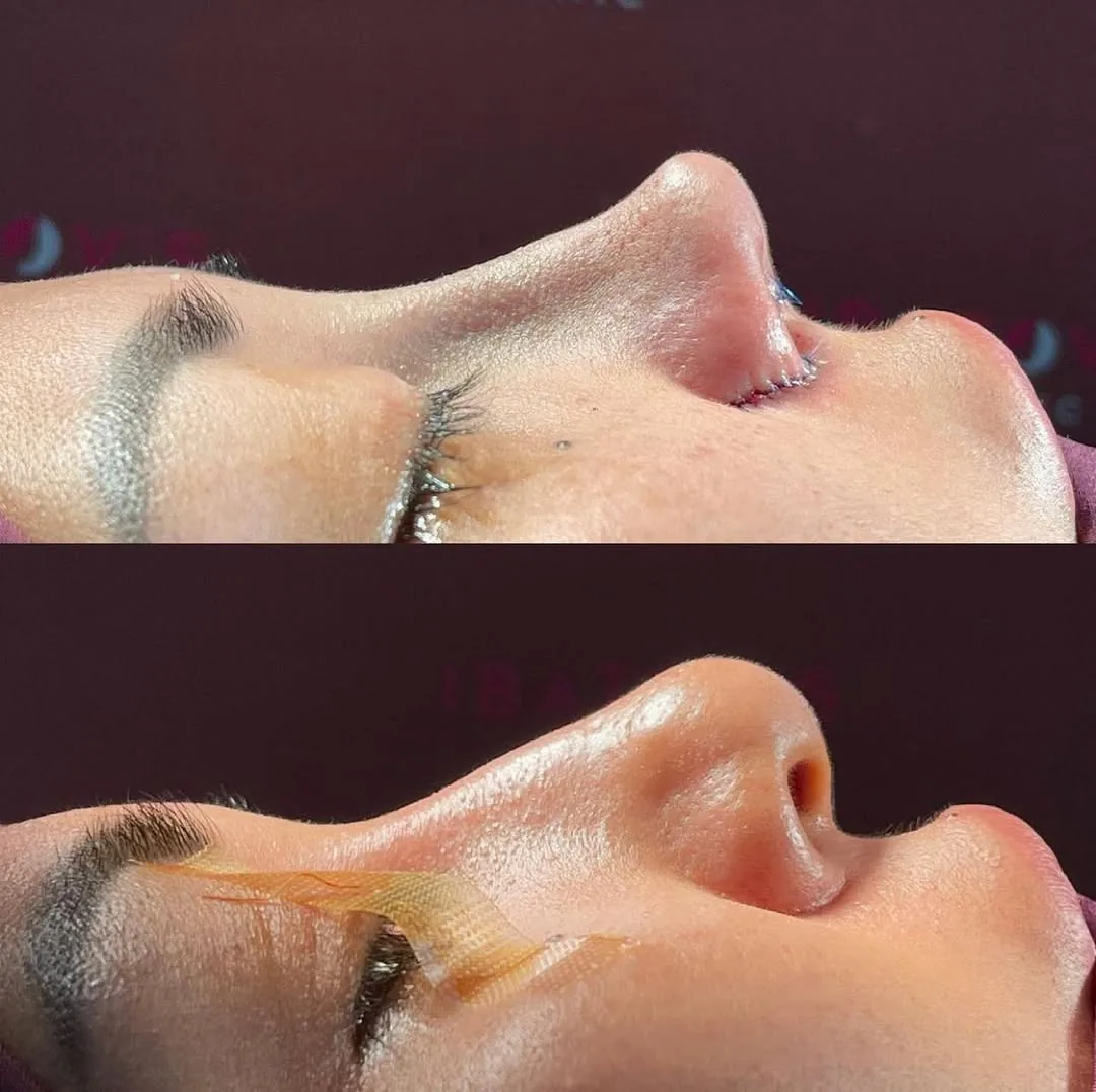 Rhinoplasty (Nose Surgery)