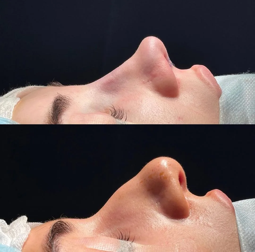 Rhinoplasty (Nose Surgery)