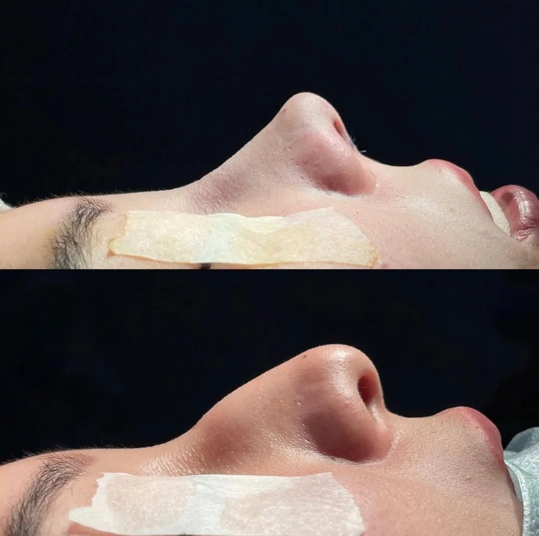Rhinoplasty (Nose Surgery)