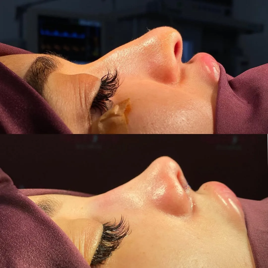 Rhinoplasty (Nose Surgery)