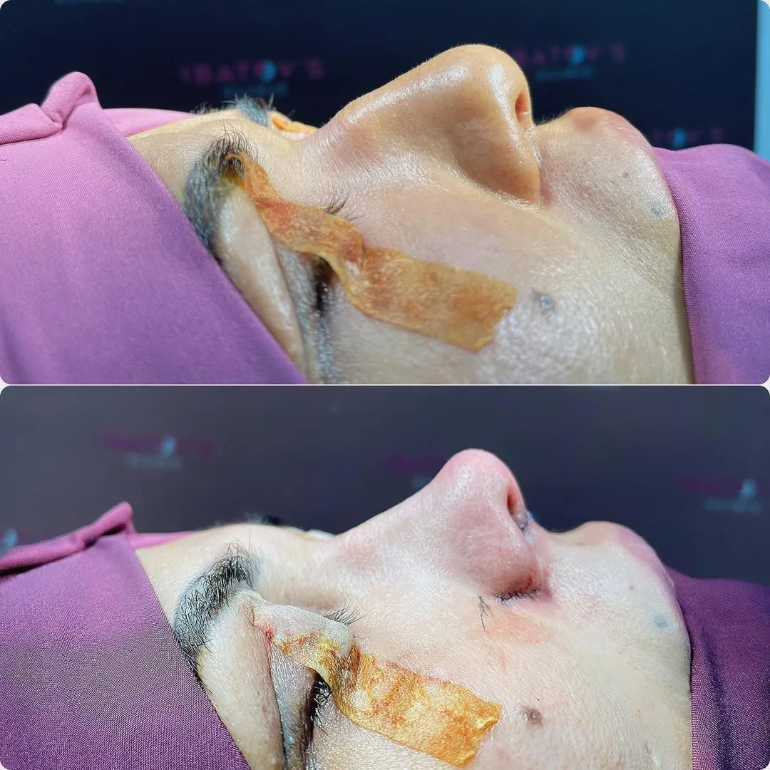 Rhinoplasty (Nose Surgery)