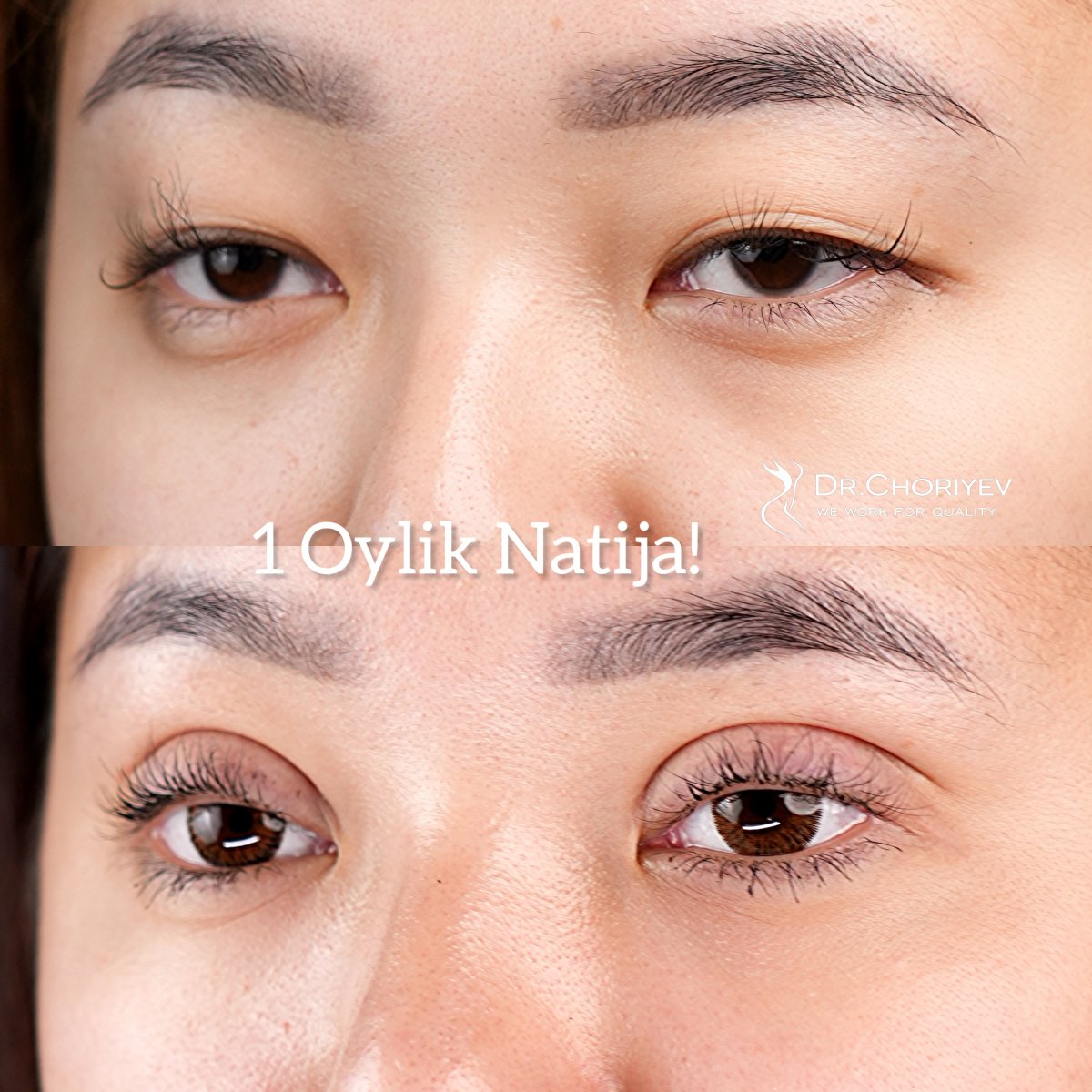 Sangapuri Tipidagi Blefaroplastika — 1 Oylik Natija | Ko'z Qovoqda Tabiiy Burma Shakllantirish | Dr. Choriyev Doniyor, Toshkent