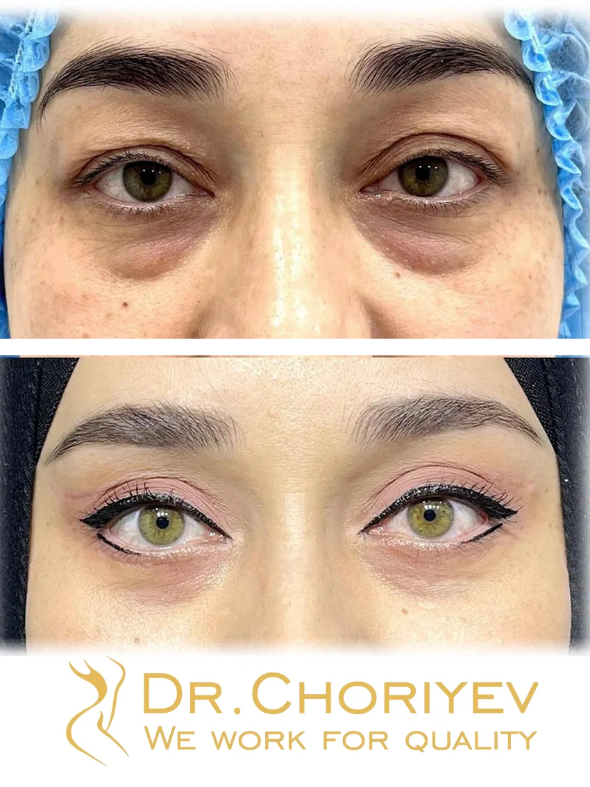 Eyelid Surgery (Blepharoplasty)