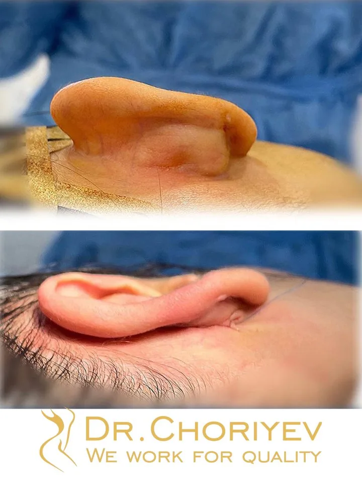 Otoplasty (Ear Surgery)