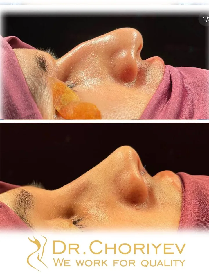 Rhinoplasty (Nose Surgery)