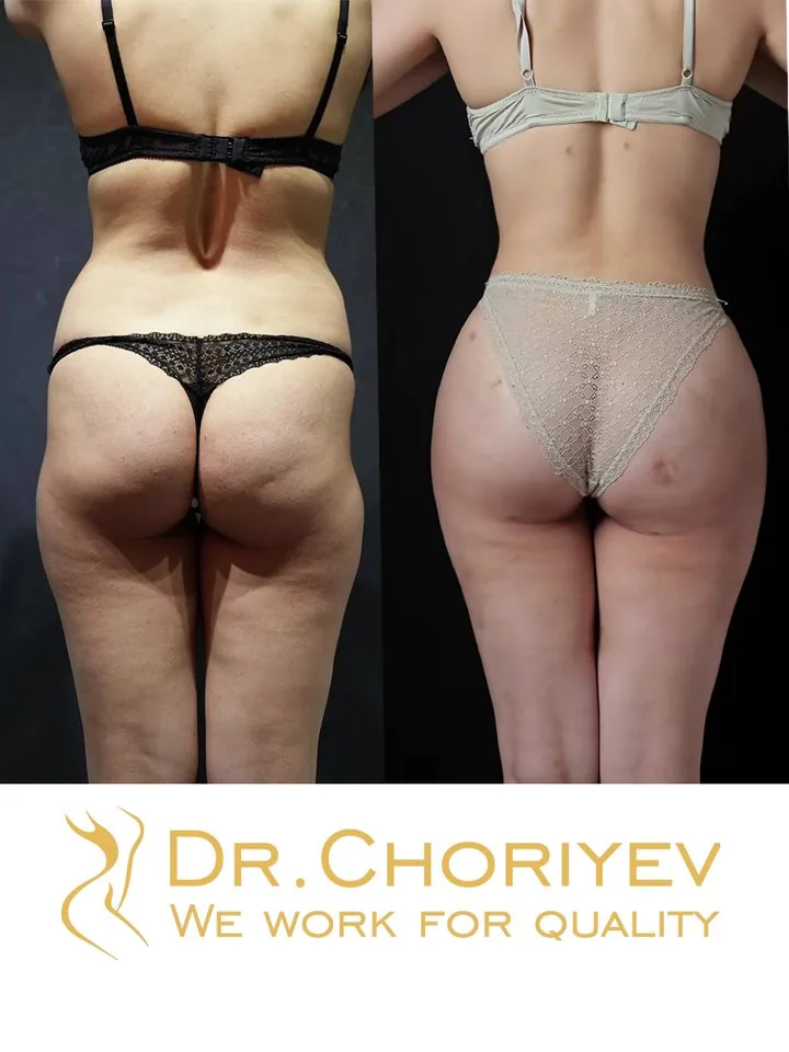 Liposuction 360°