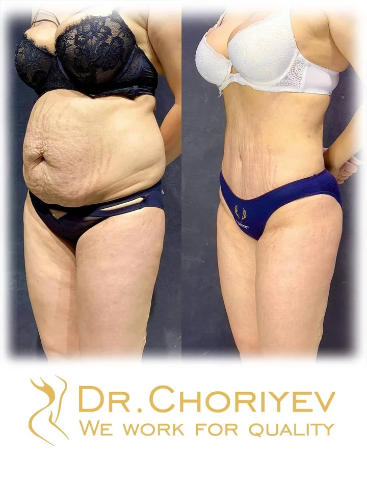 Abdominoplasty (Tummy Tuck)